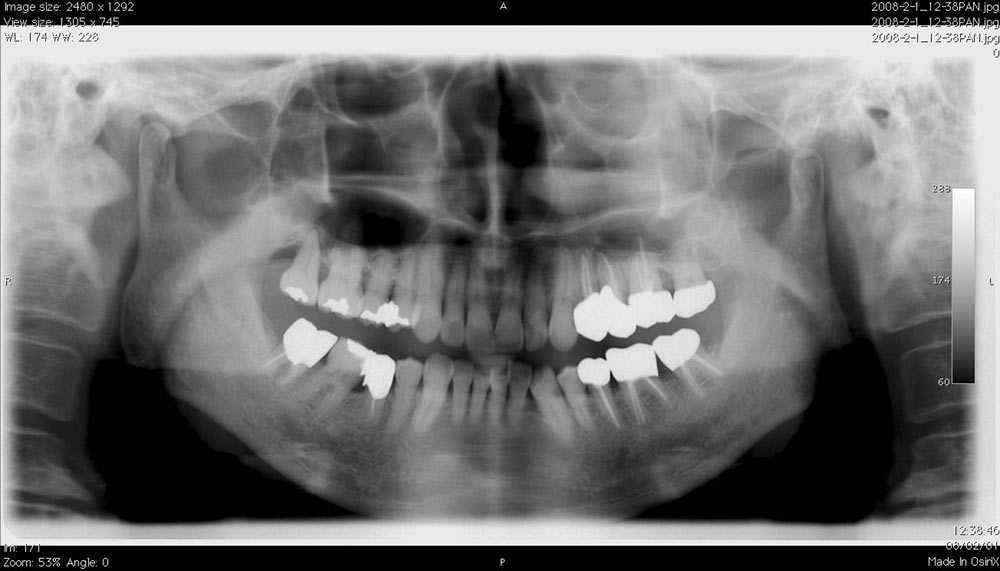 3)CT画像の情報量 -上顎洞疾患１-