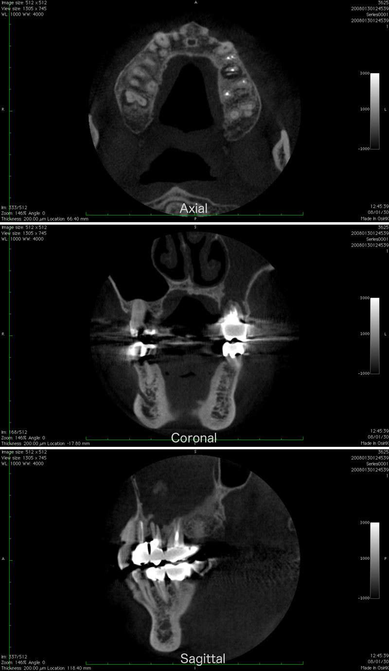 3)CT画像の情報量 -上顎洞疾患１-
